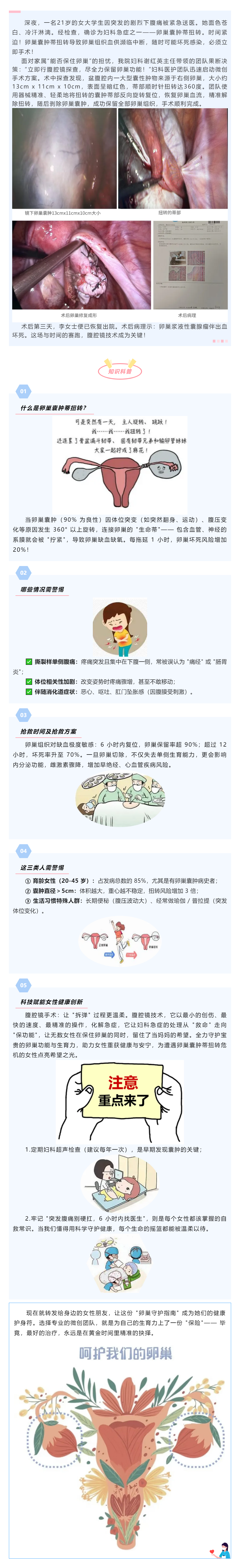 【科普】卵巢囊肿蒂扭转——不可忽视的“妇科急腹症”.png